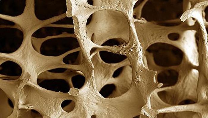 cropped-osteoporosis